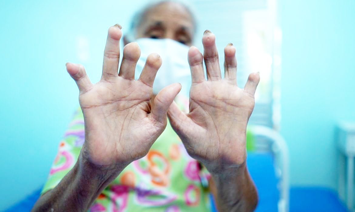 Campanha Janeiro Roxo conscientiza sobre a hanseníase e sua prevenção